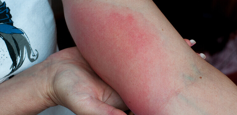 A person's red and swollen arm from a wasp sting.